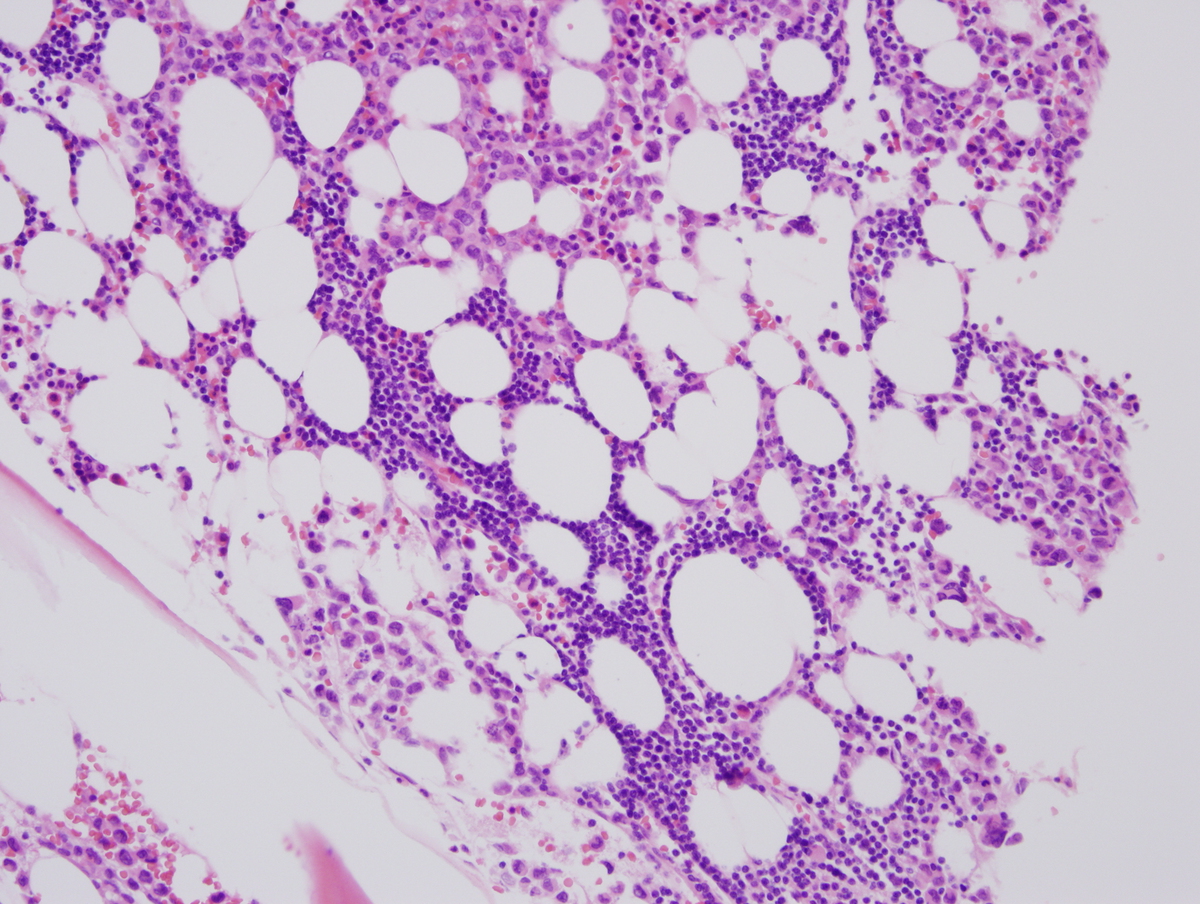 Fig. 9 Bone marrow core biopsy. Ill-defined interstitial lymphoid aggregates composed of small mature appearing lymphocytes are noted in addition to the blasts (Fig. 9a). The lymphocytes are positive for CD20 (Fig. 9b) and CD5 (Fig. 9c) by immunohistochemistry. CD3 (Fig. 9d) highlights scattered T-cells.